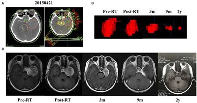 Fractionated Radiation Therapy for Large and Giant Cavernous Sinus Hemangioma: A Retrospective Study